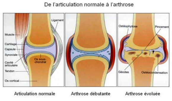 arthrose